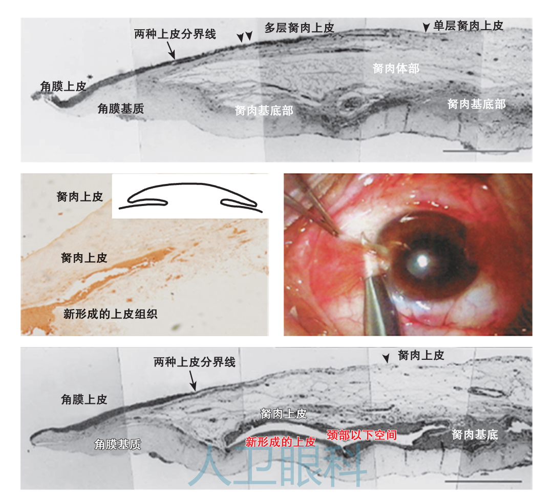 如何做好翼状胬肉手术切口的选择?