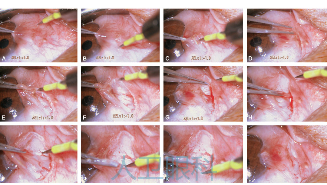 如何做好翼状胬肉手术切口的选择?