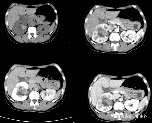 肾癌图片 ct增强扫描图片