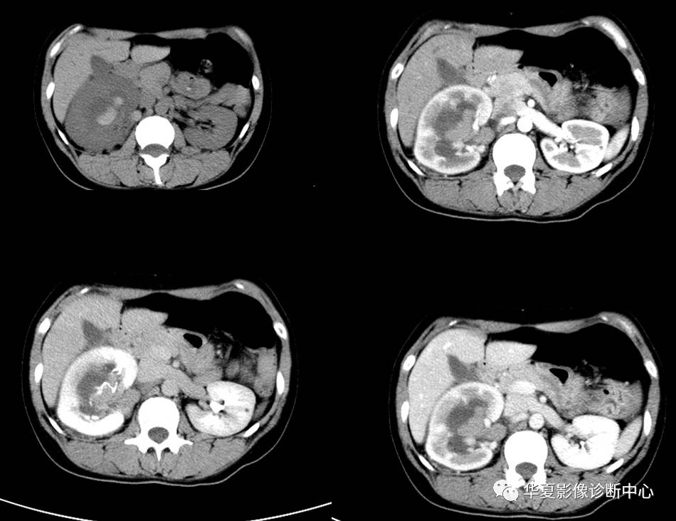 分享病例:肾脏嫌色细胞癌