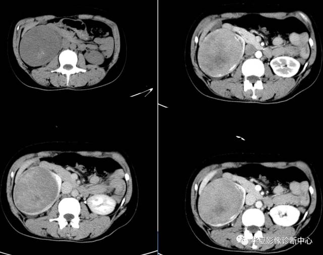 肾癌增强ct图片图片