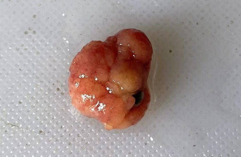 绒毛状腺瘤,局灶高级别上皮内瘤变,基底切缘未见