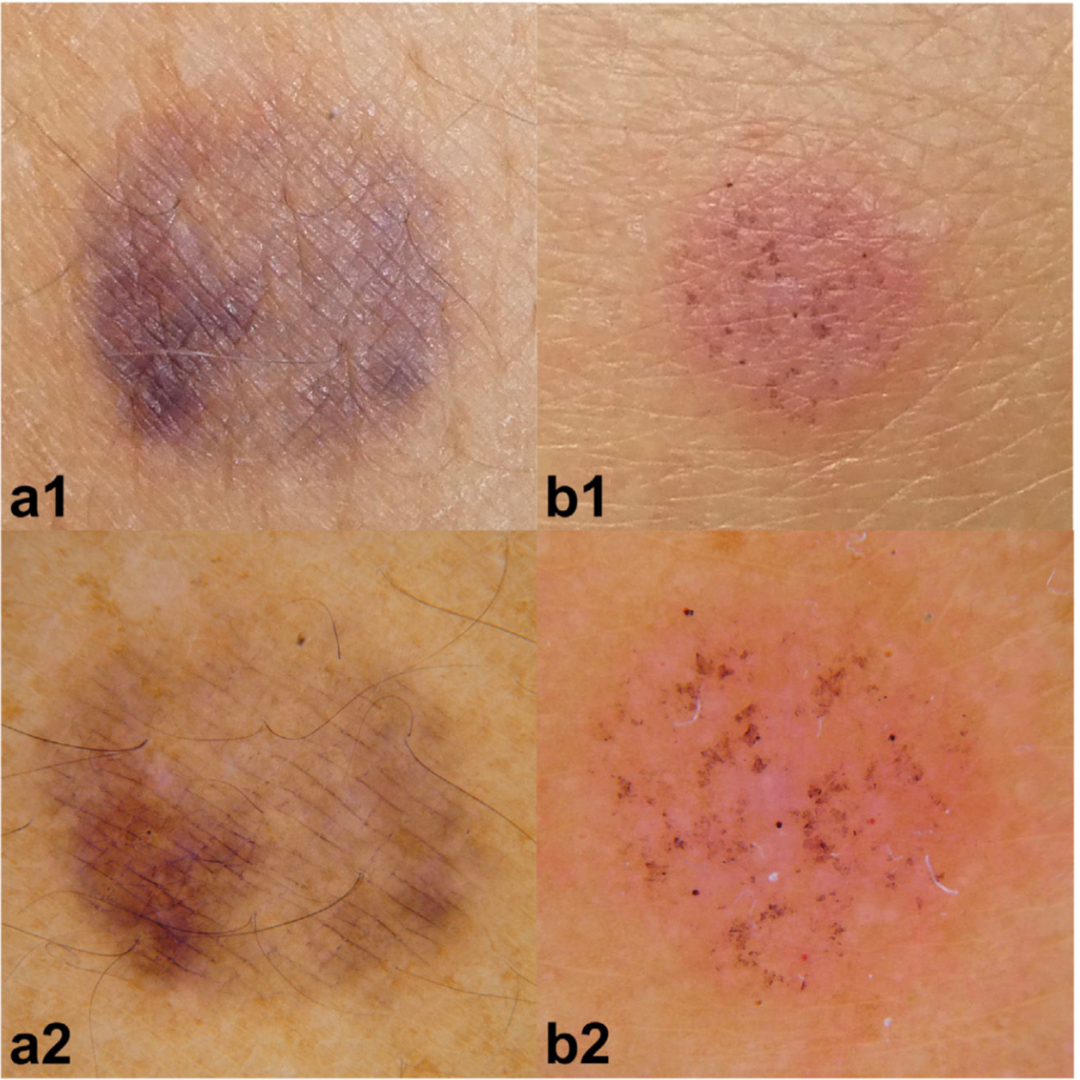 85D12 | 免疫性血小板減少性紫斑病 国試 | M3E Medical