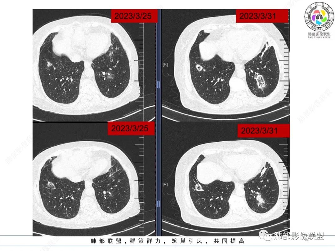 你要的高清无码——肺部CT常见十大征象诊断应用，还不收藏_支气管