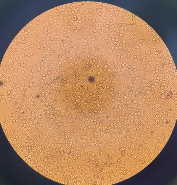 反复高热与腹泻,幕后元凶竟是这般生物:阿米巴寄生虫