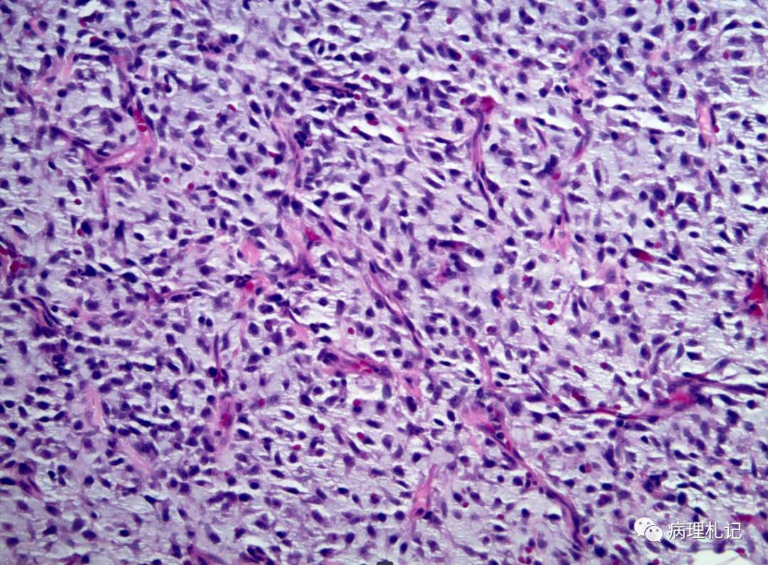 病理视角|粘液样脂肪肉瘤转移到肺_医学界-助力医生临床决策和职业