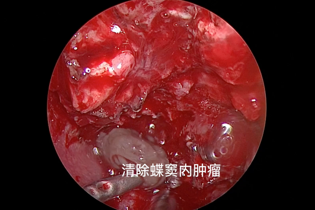 楼美清教授:神经内镜显微技术治疗鼻颅眶沟通性肿瘤