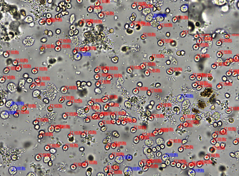 大便镜检白细胞图片图片