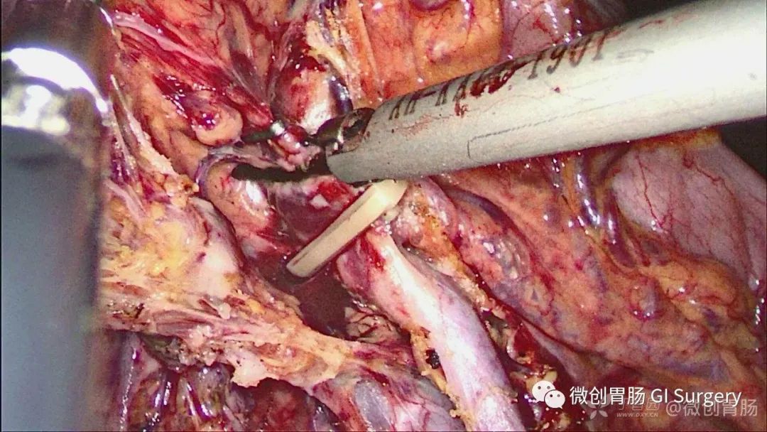腹腔镜右半结肠解剖系列——动脉导向胃结干解剖