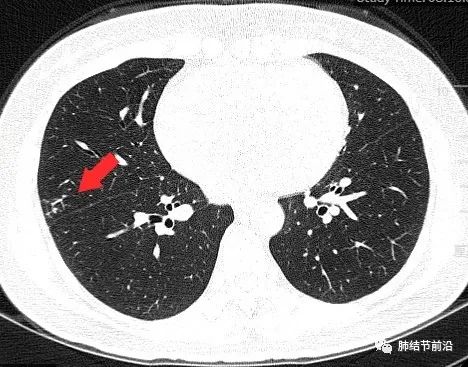 肺部实性结节图片图片