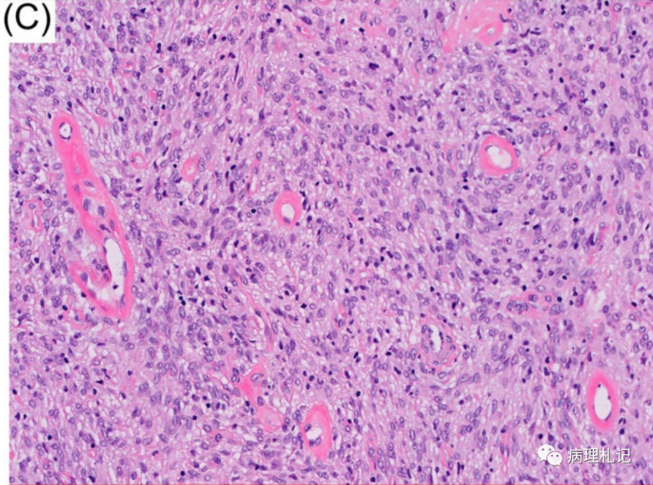 病理視角8例激酶融合陽性的骨內梭形細胞腫瘤病例學習