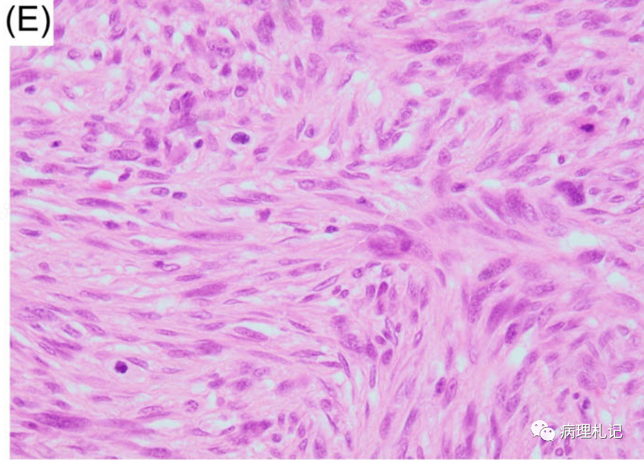 病理視角8例激酶融合陽性的骨內梭形細胞腫瘤病例學習