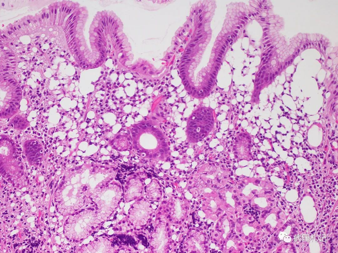 病理视角 | 8例激酶融合阳性的骨内梭形细胞肿瘤病例学习