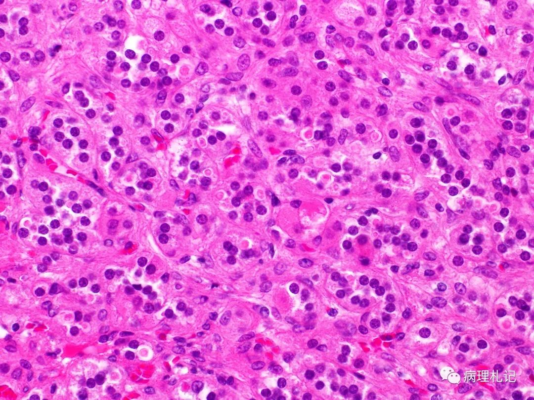 病理视角 | 8例激酶融合阳性的骨内梭形细胞肿瘤病例学习