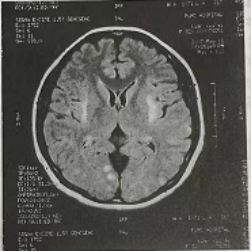 炎性脫髓鞘疾病如何診治一個病例訓練你的臨床思維