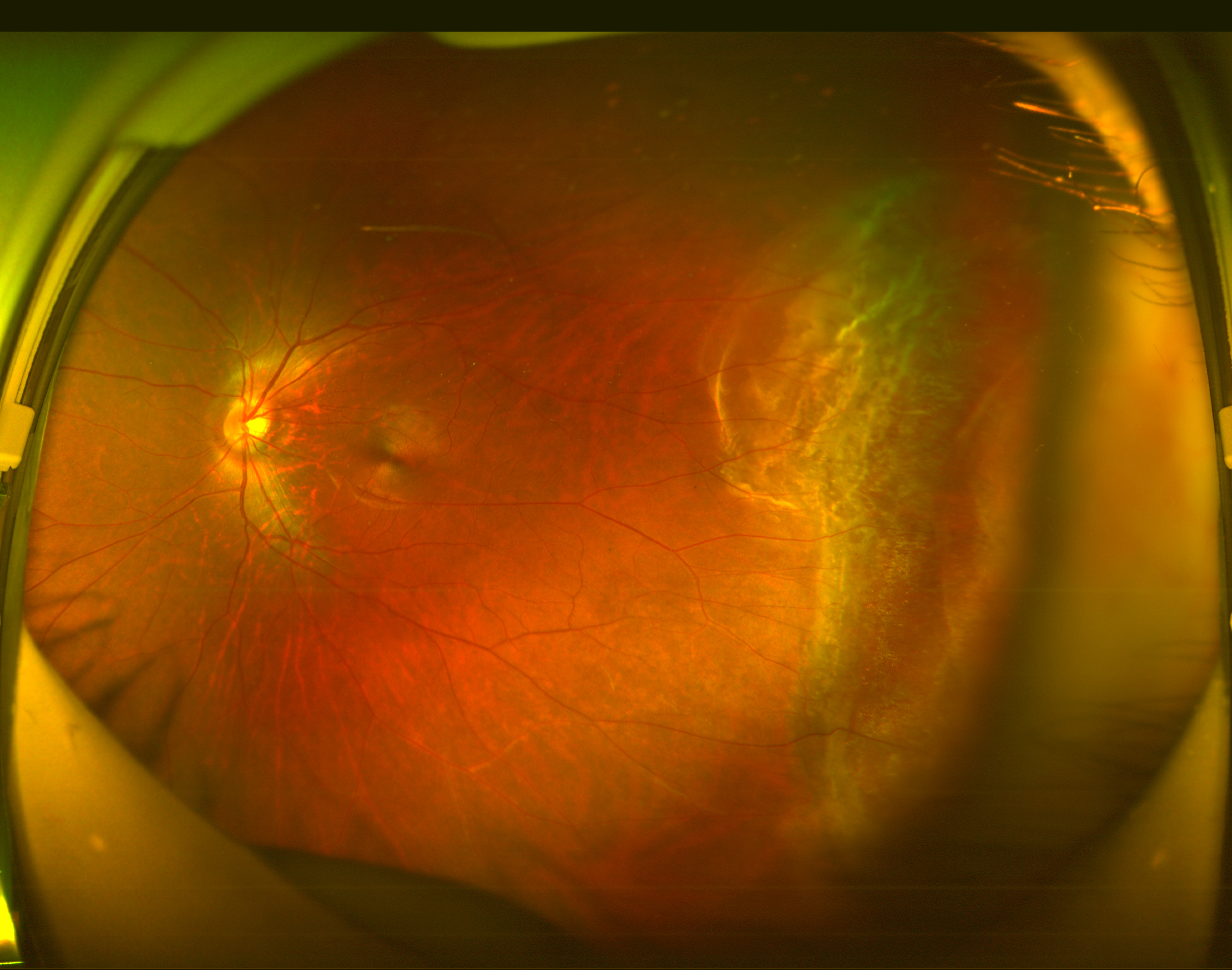 15岁青少年双眼视网膜脱离,竟是因为