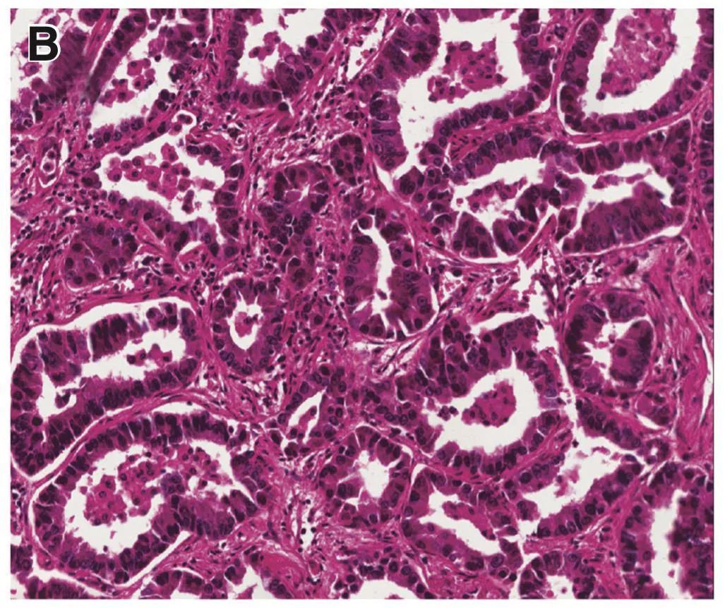 肺癌术后病理提示有微乳头成分,预后更不好?