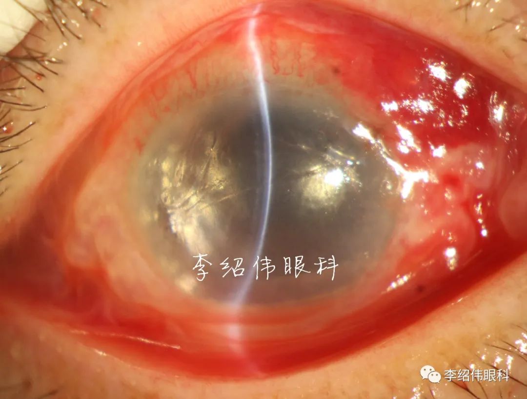 白内障术后角膜水肿2月