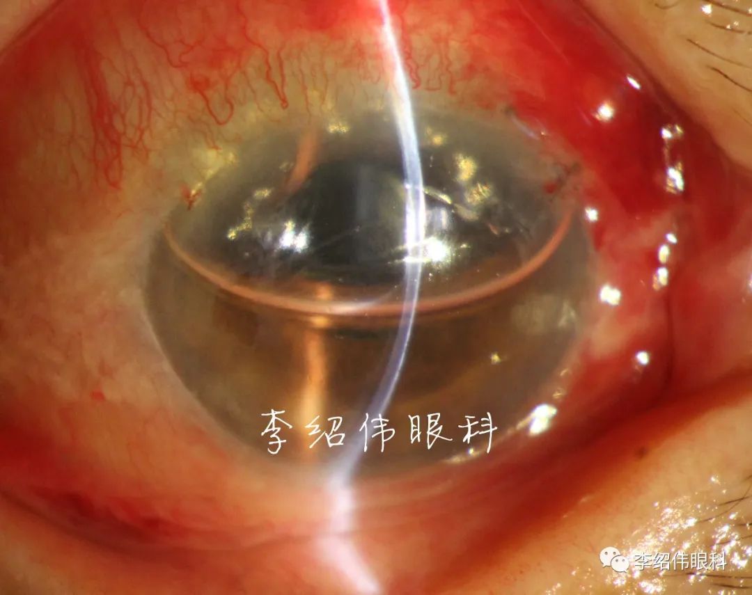 白内障术后角膜水肿2月