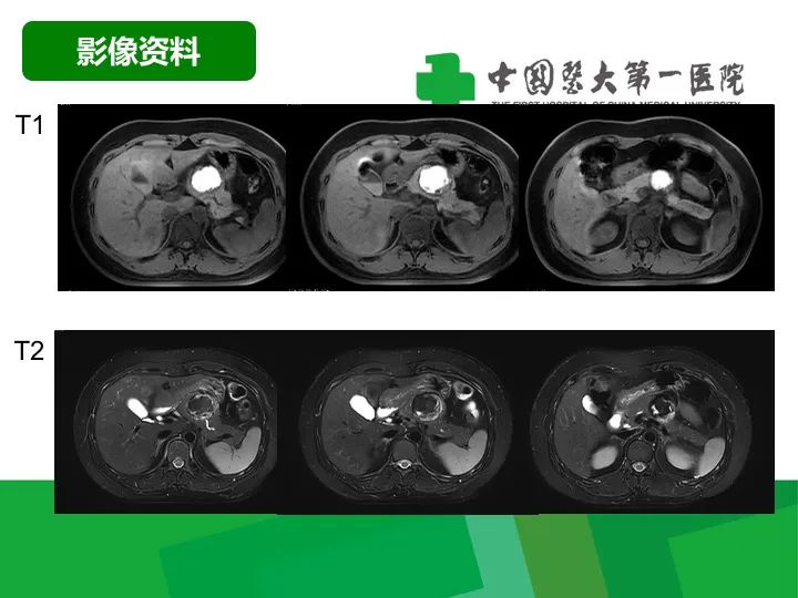 胰腺实性假乳头状瘤