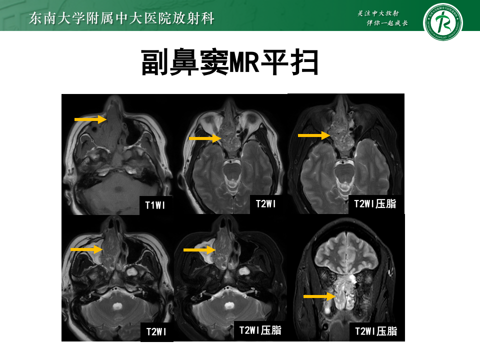 罕见丨嗅神经母细胞瘤