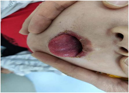 图2 杨梅舌图3 疹退后片状脱皮看到这里，你知道宁宁的诊断是什么了吗？该
