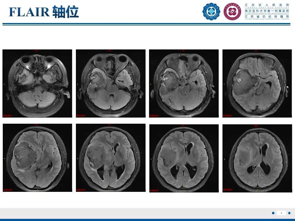 颅内畸胎瘤影像诊断