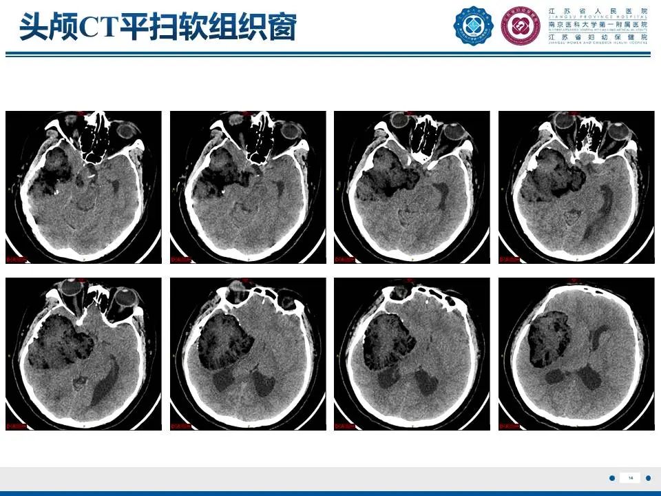 颅内畸胎瘤影像诊断