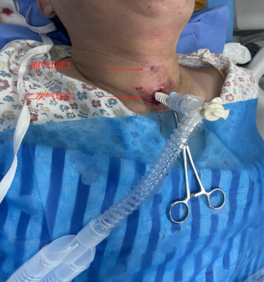 一例高位气管切开术后气道狭窄患者的治疗