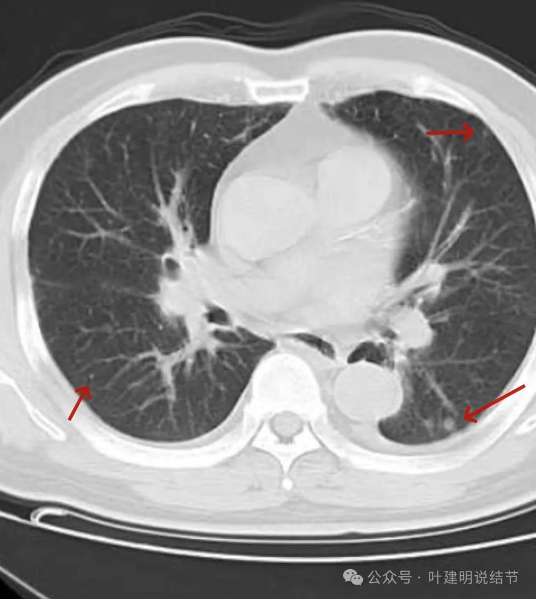 误以为是恶性结节,千万别忽视影像的局限!