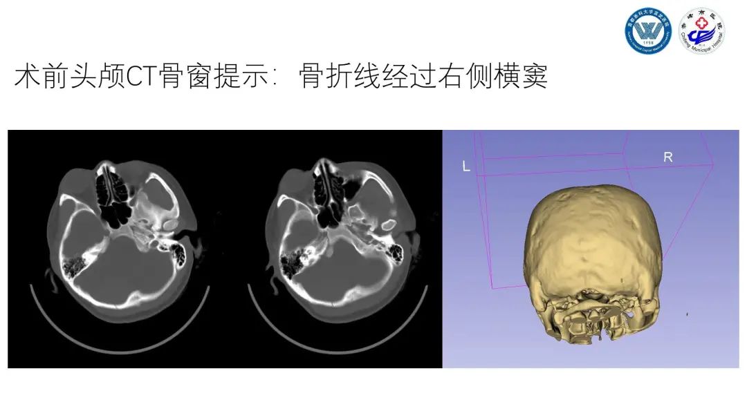 枕骨骨折致横窦出血引起幕上下硬膜外血肿手术1例