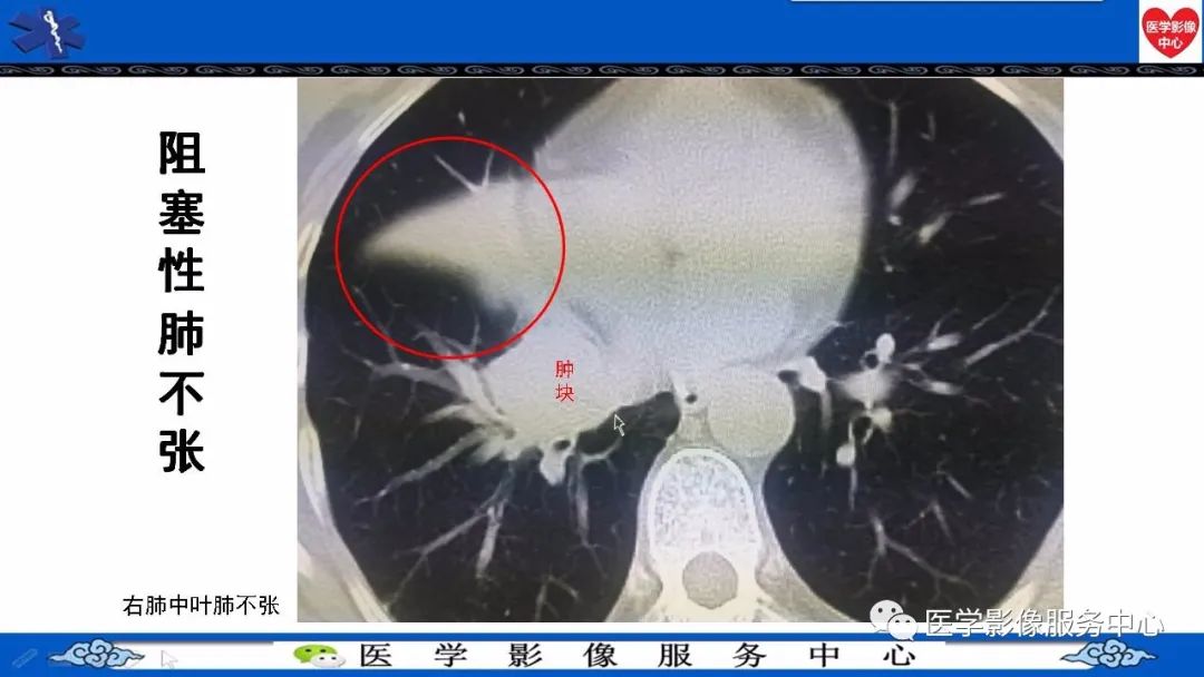 中央型肺癌常见图片