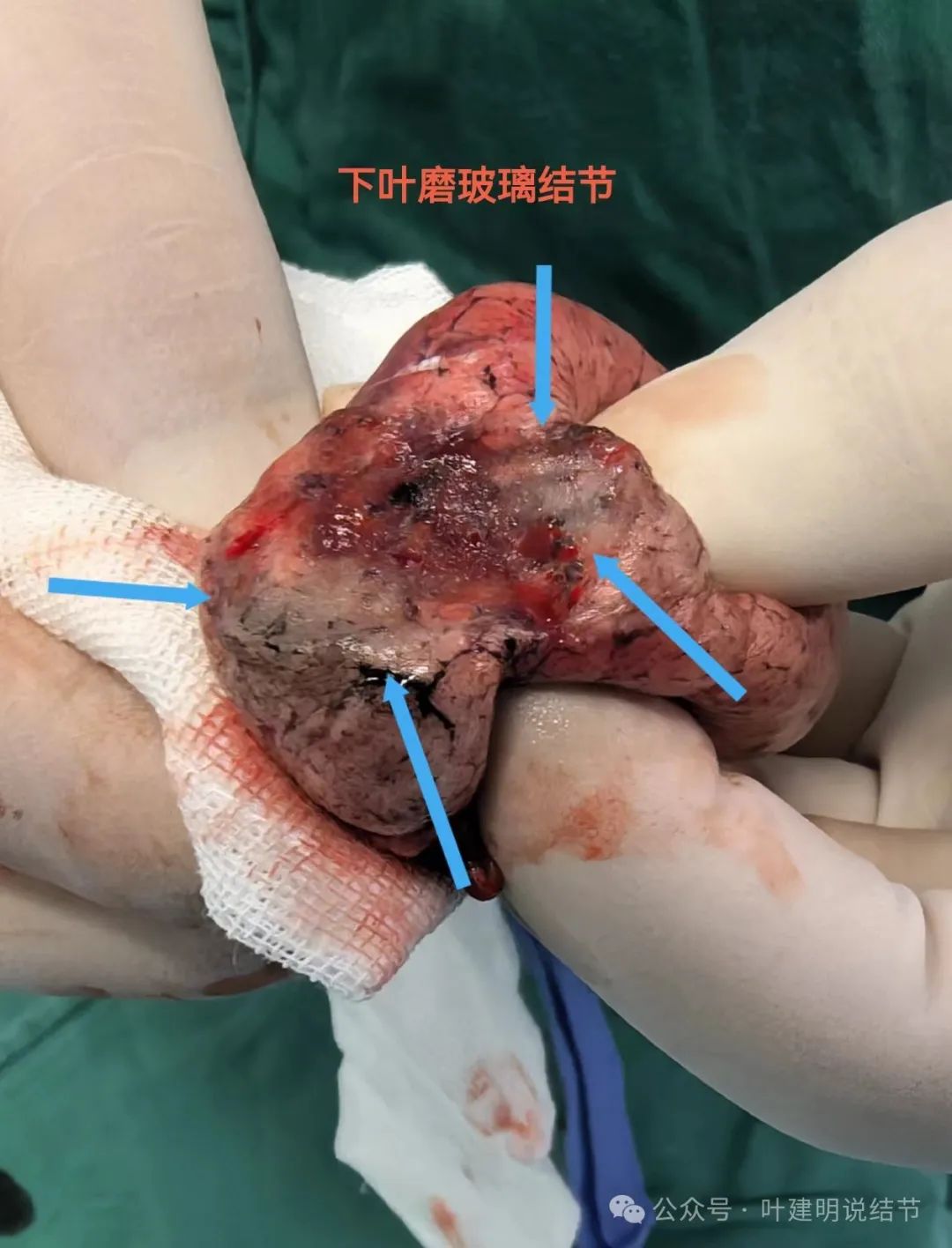 判断肺结节的良恶性以及恶性程度,密度很重要,但不能只在乎密度!