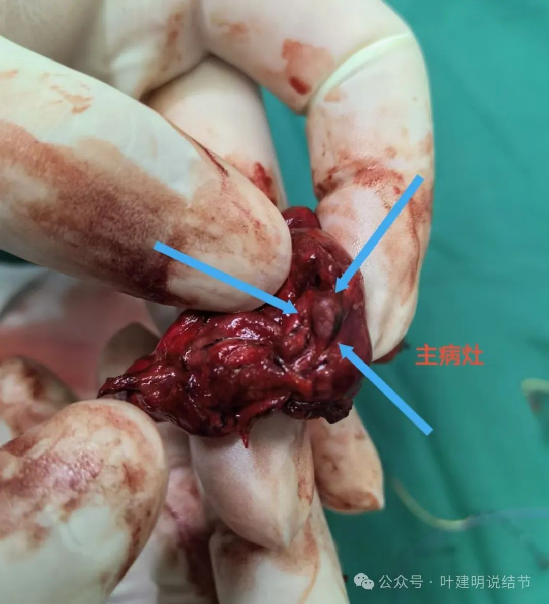 原位腺癌被剔除出肺癌,要不要开刀结合实例一文讲透彻!