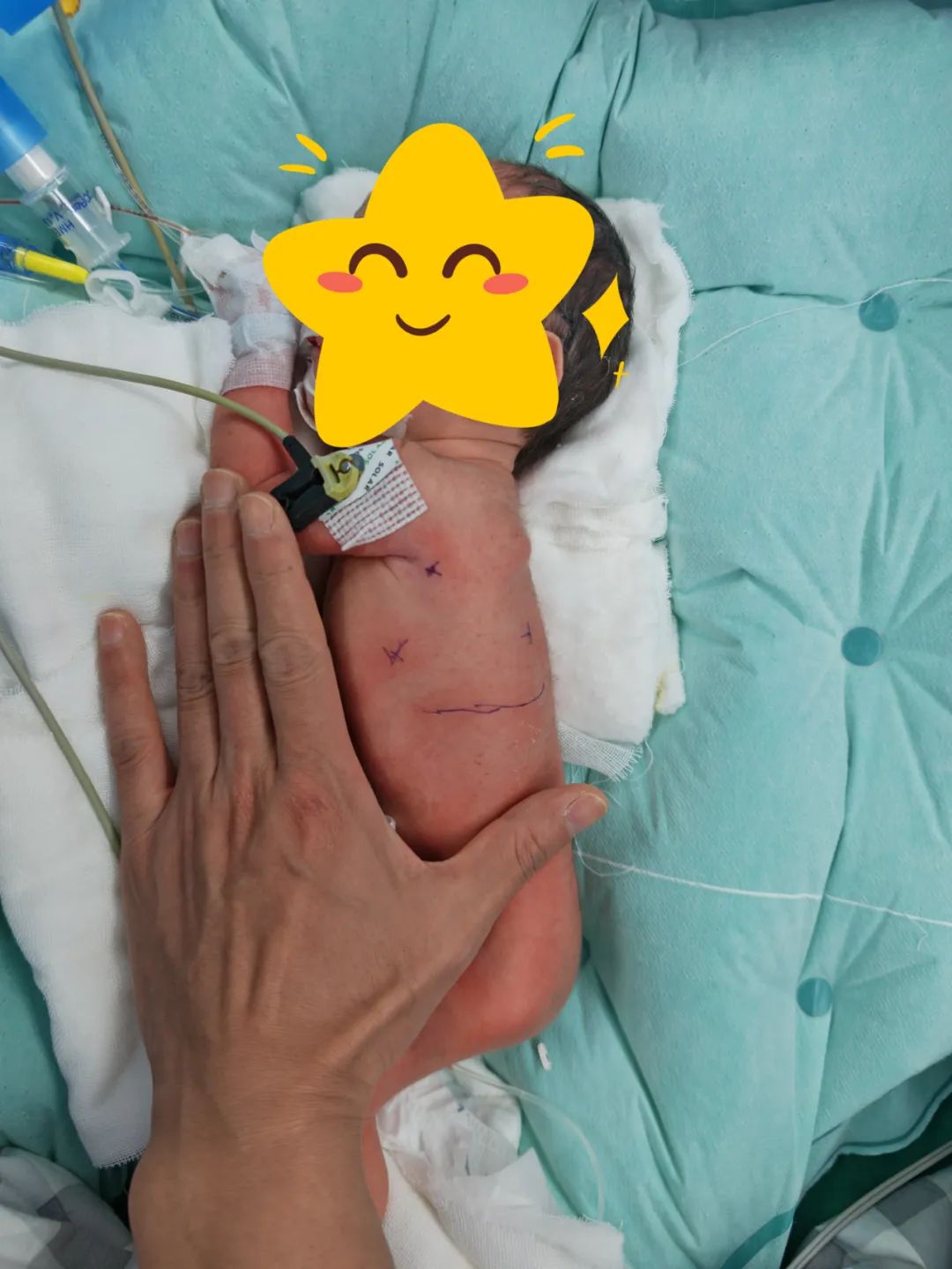 35周早产儿肠道"钻进"胸腔,医生为他微创补"漏"