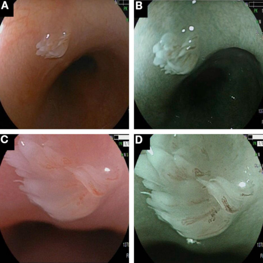 食管乳头状瘤样增生图片