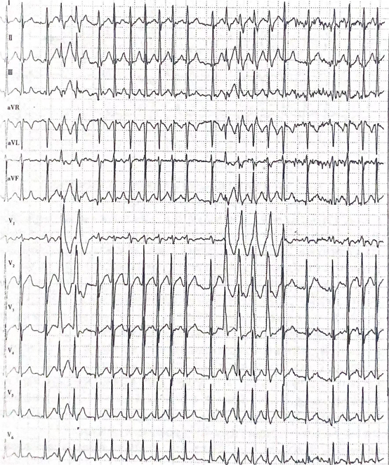 83岁老年男性室性期前收缩(0610)