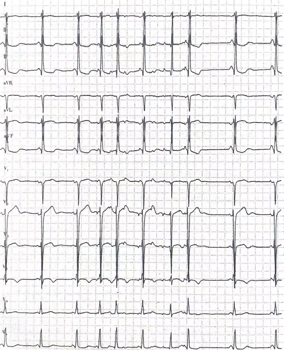 昨日心电图参考解析仅供医学专业人士阅读参考