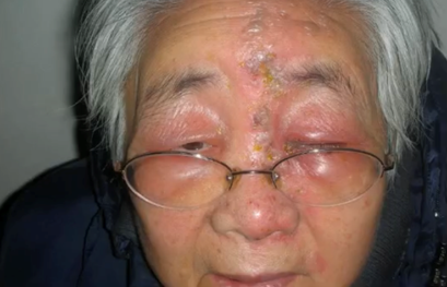 八大特殊类型疱疹知多少?