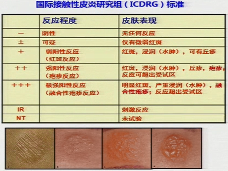 一查吓一跳你常认为的湿疹唇炎很可能是接触性皮炎