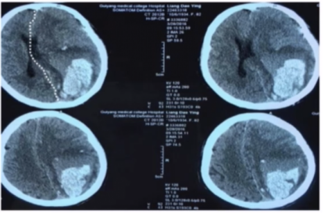 大量脑出血并天幕疝急救流程与要点速速掌握