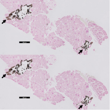 图4 心内膜心肌活检冠状动脉造影各支冠脉未见有意义狭窄,血清钙含量