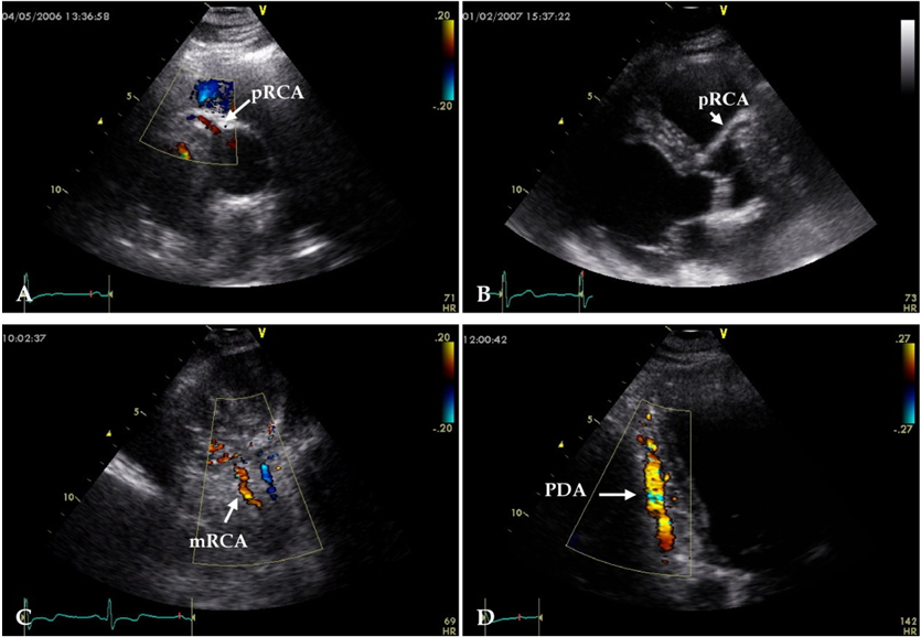 创新自由谈丨能否使用超声心动图评估冠状动脉?