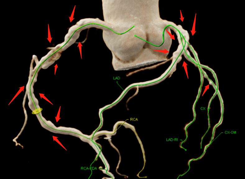 如何通过冠状动脉钙化启动他汀及阿司匹林治疗