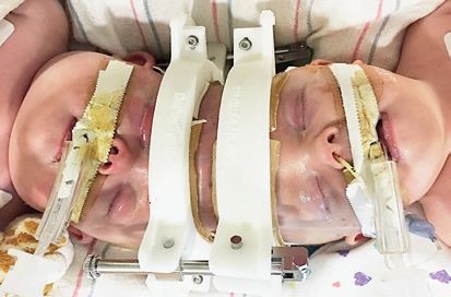 成功了!史上最难连体婴顺利分离