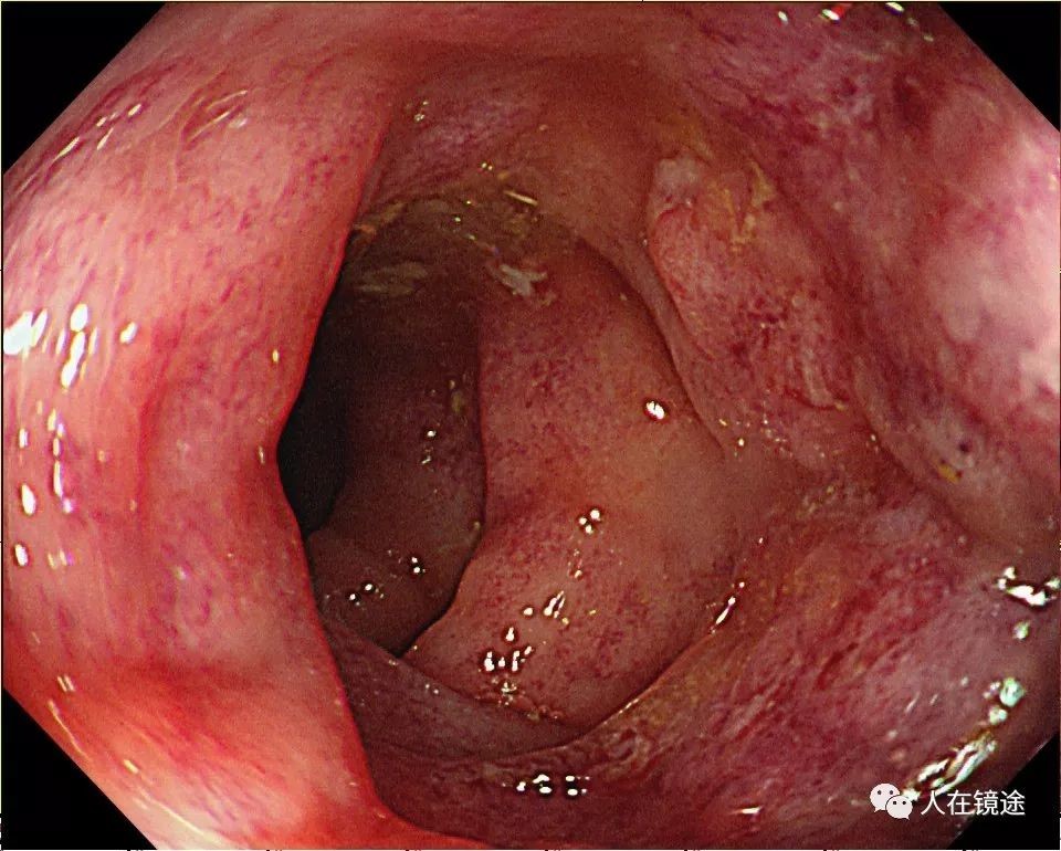 而再来我院检查,做电子结肠镜检查见距肛门45cm以下降结肠及乙状结肠