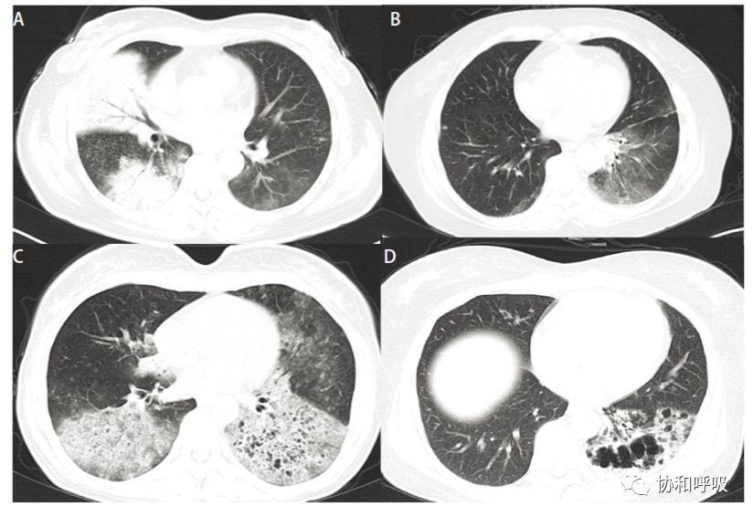 图 3 : 肺炎型肺癌的影像学表现