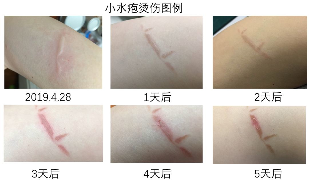 伤口结痂就是要愈合了 小心 这八个谣言会加重你的伤情 医学界 助力医生临床决策和职业成长