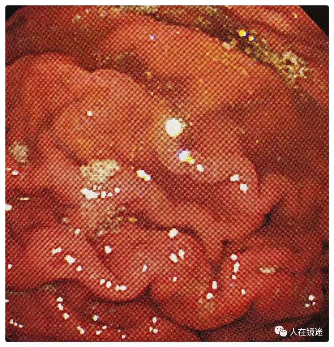 幽门螺旋杆菌胃镜图片图片
