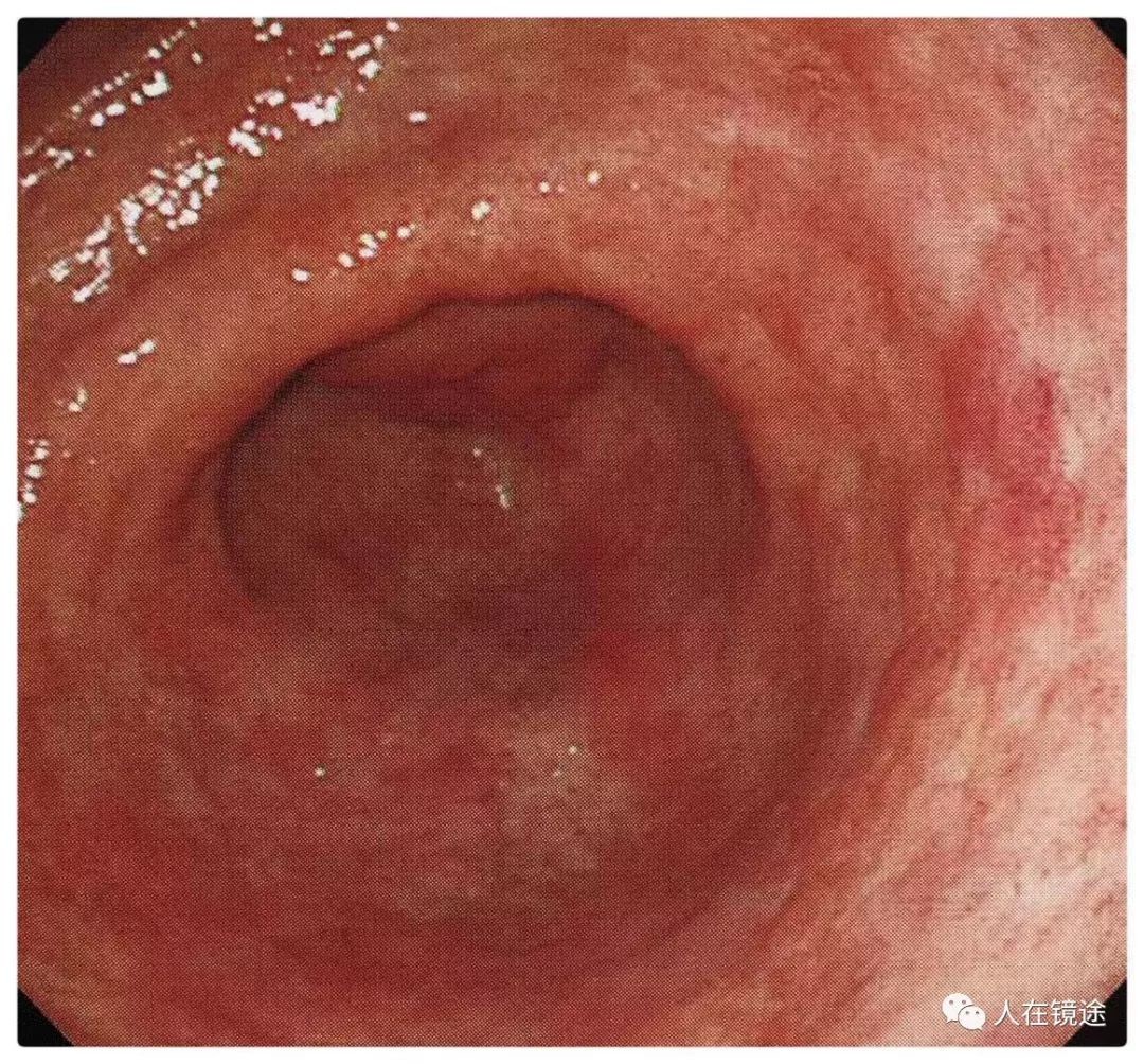 基层医院普通白光内镜诊断幽门螺旋杆菌感染技上杲鈅医